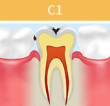 虫歯の進行段階と治療法_02
